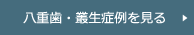 八重歯・叢生症例を見る