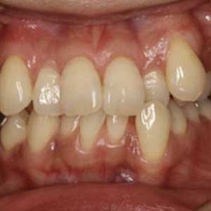 八重歯・叢生の歯科矯正治療例