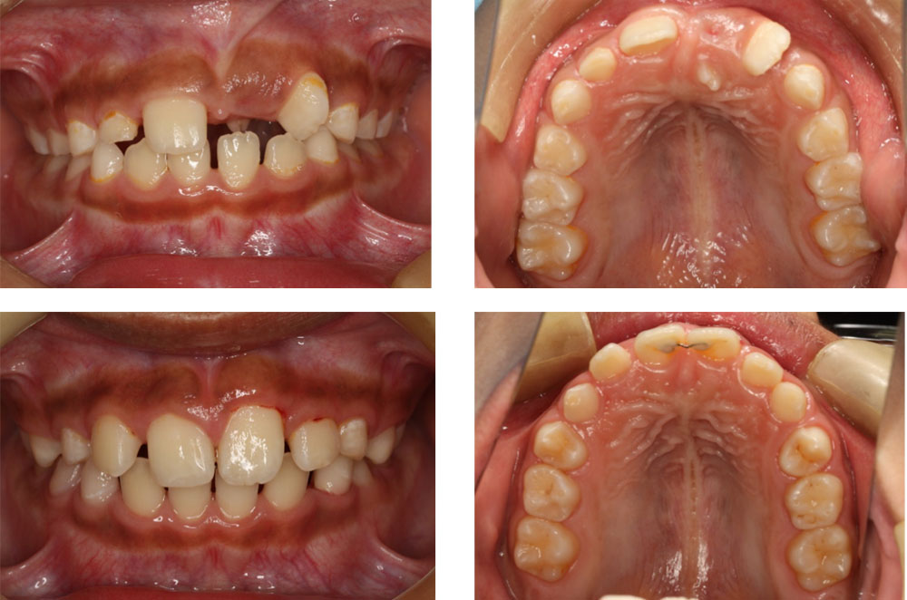 子どものすきっ歯の治療例