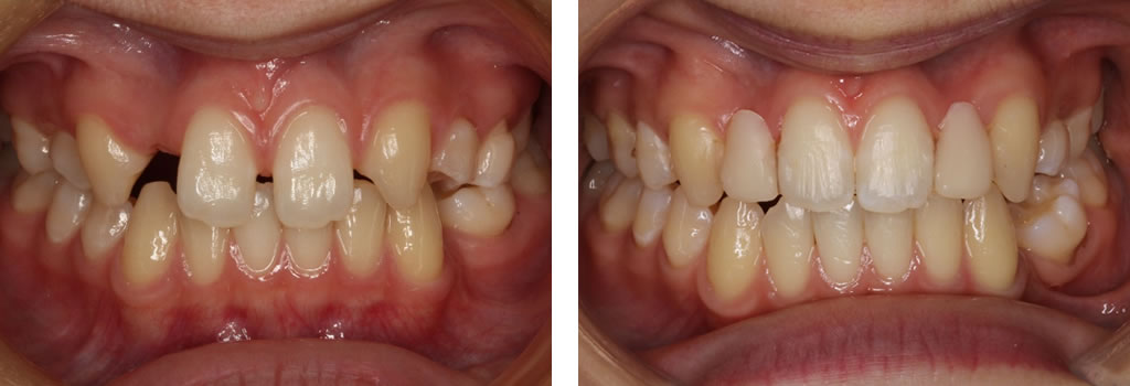 子供のすきっ歯の矯正治療例（15歳女児 治療期間2年3ヶ月）