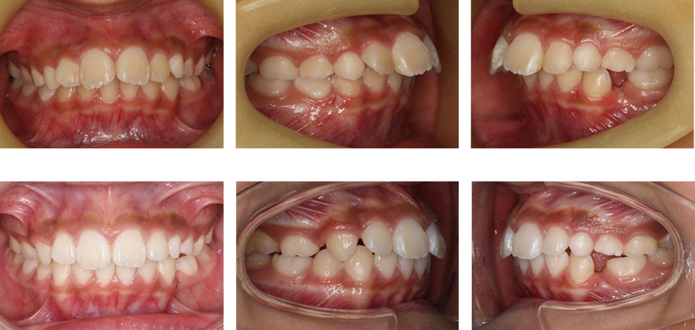 子どもの出っ歯の歯並び矯正治療 東京都港区麻布十番のuc矯正歯科