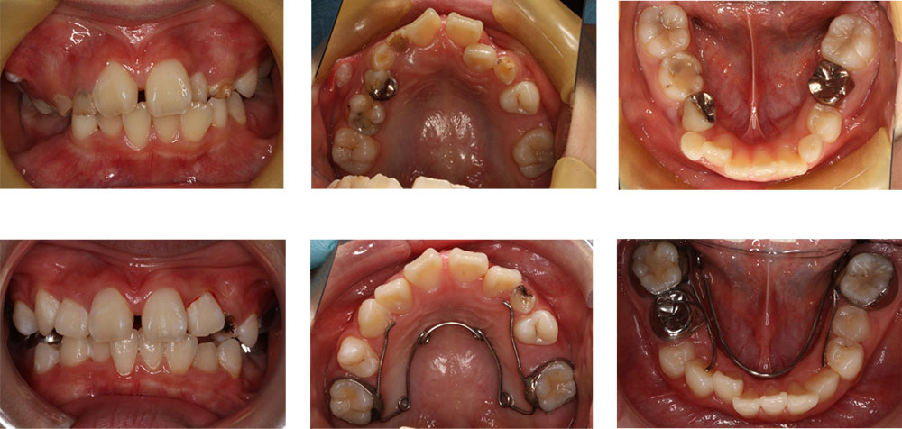 子供の八重歯・叢生の治療例