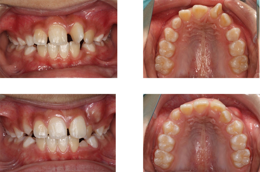 子どもの八重歯・叢生の治療例