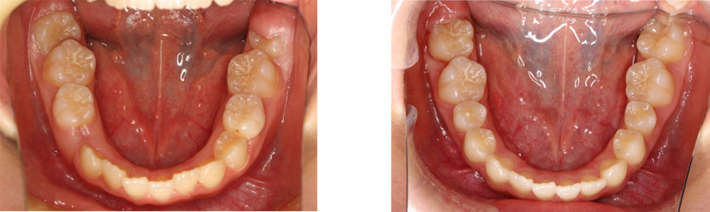 子供の八重歯・叢生の治療例