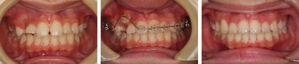 子供の八重歯・叢生の矯正治療例（11歳女児 治療期間4年3ヶ月）