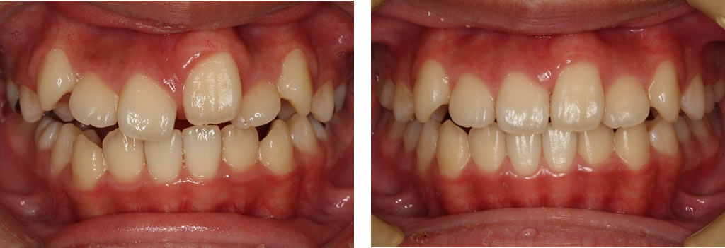 子供の八重歯・叢生の矯正治療例（11歳女児 治療期間6ヶ月）