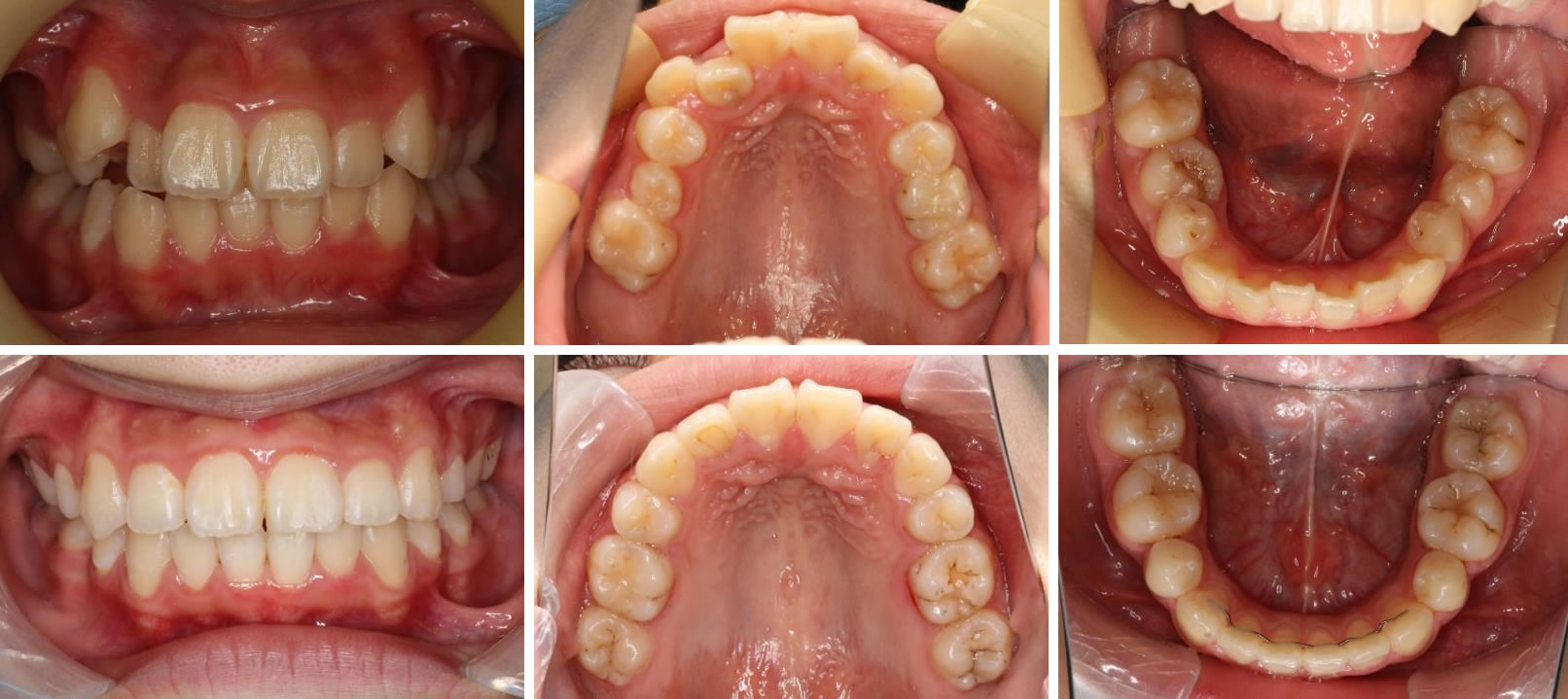 子供の八重歯・叢生の矯正治療例（14歳女子 治療期間3年8ヶ月）
