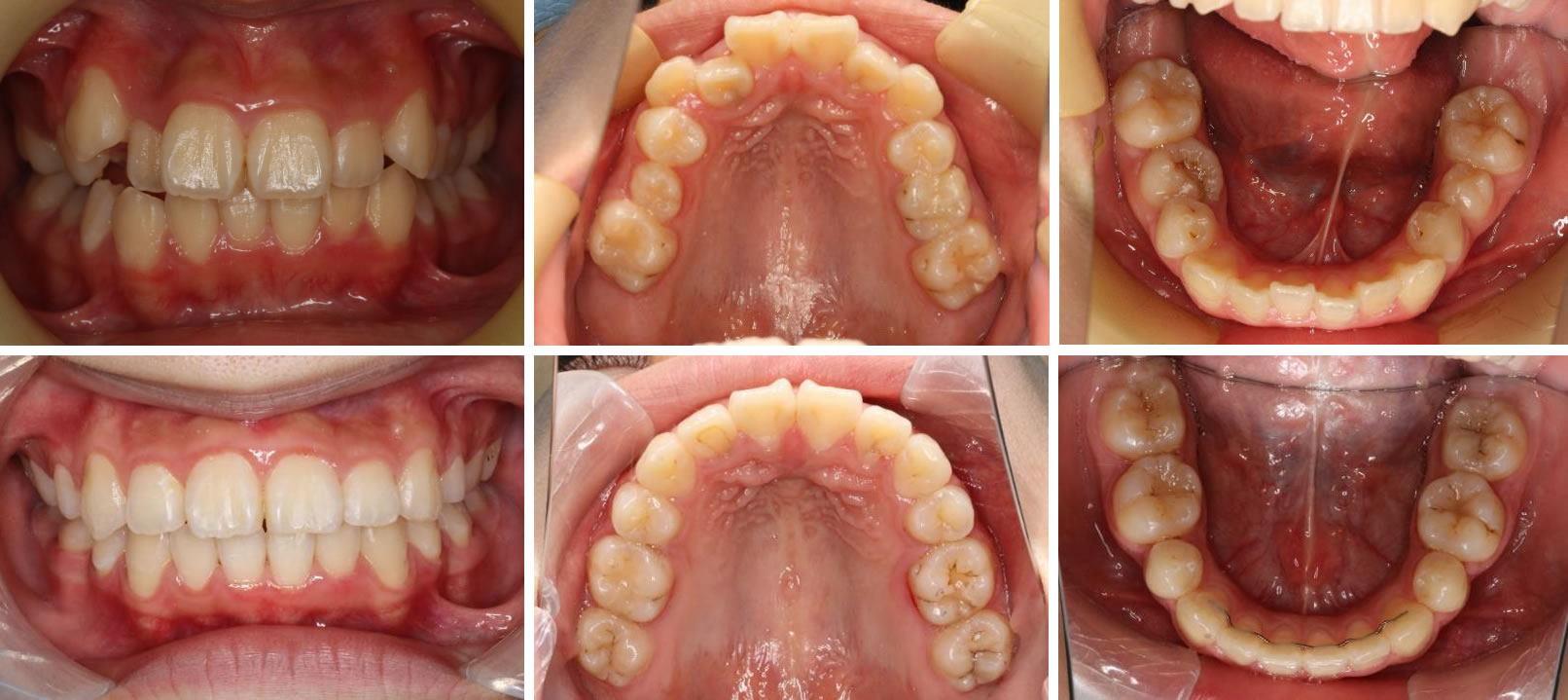 子供の八重歯・叢生の治療例