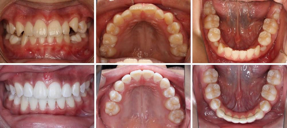子供の八重歯・叢生の治療例