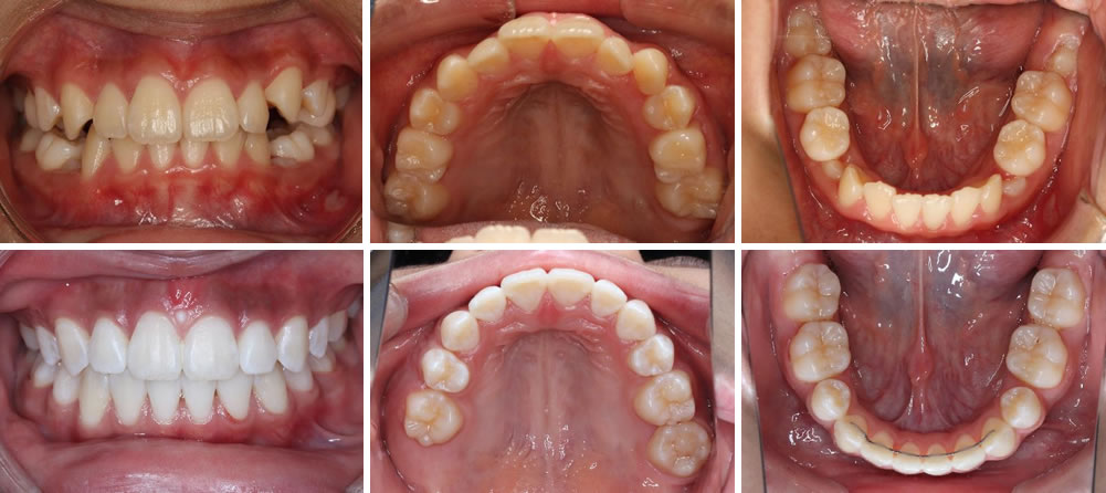 子供の八重歯 叢生の矯正治療例 Uc矯正歯科クリニック麻布十番 東京港区