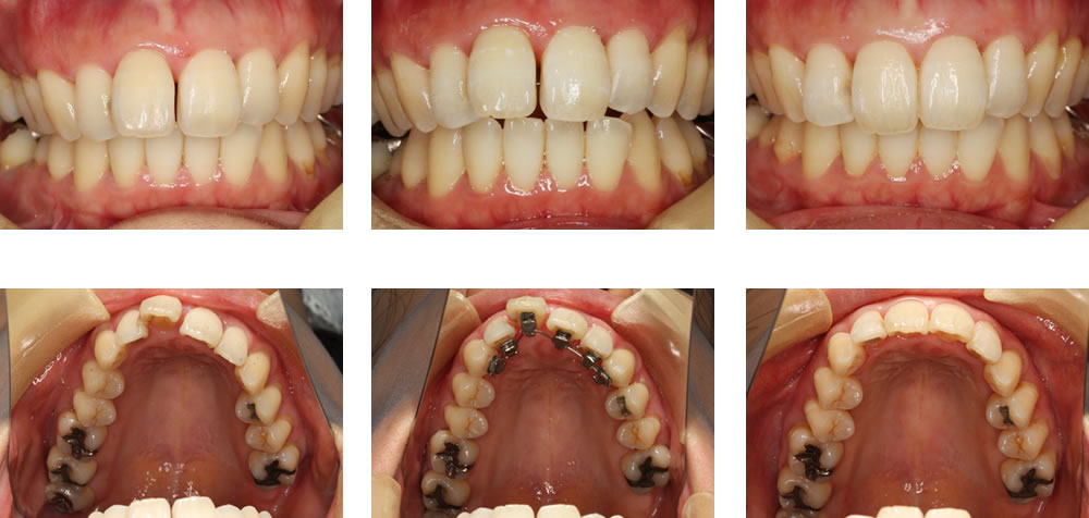 部分矯正の矯正治療例