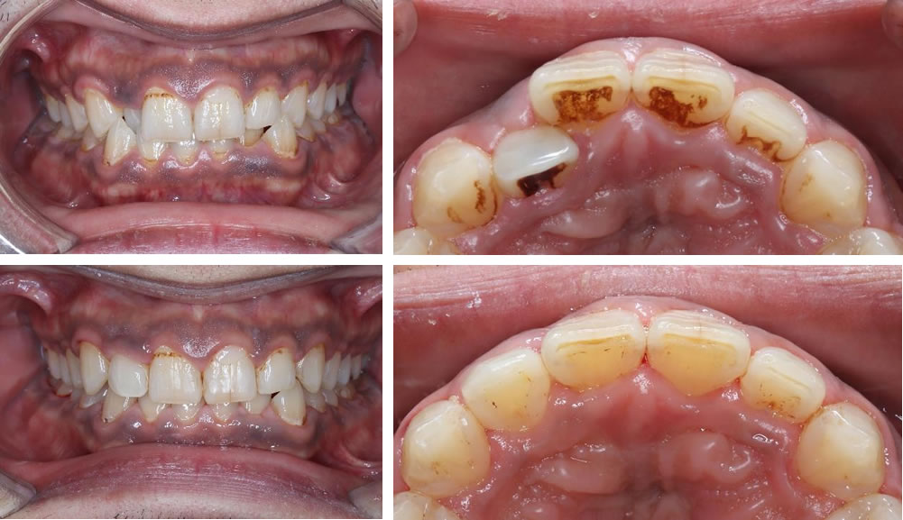 前歯の部分矯正(MTM)の治療例（30代男性 治療期間4ヶ月）