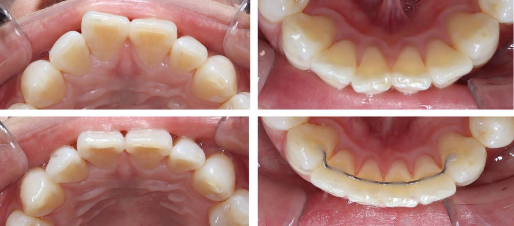 前歯の部分矯正(プチ矯正)の矯正治療例