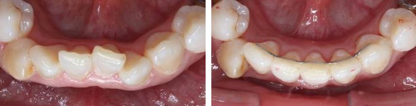 前歯の部分矯正(プチ矯正)の治療例（30代女性 治療期間5ヶ月）