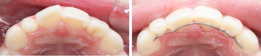 前歯の部分矯正(プチ矯正)の矯正治療例