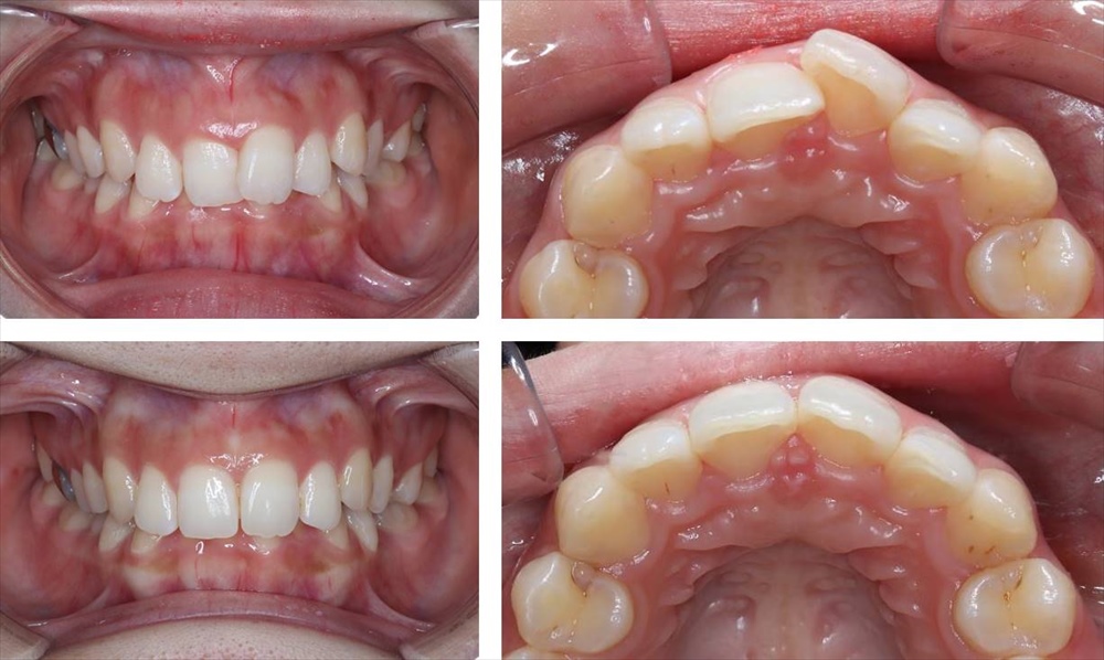 前歯の部分矯正(マウスピース矯正)の治療例（20代女性 治療期間5ヶ月）
