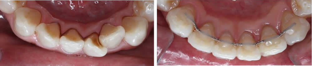 前歯の部分矯正(マウスピース矯正)の治療例（40代男性 治療期間6ヶ月）