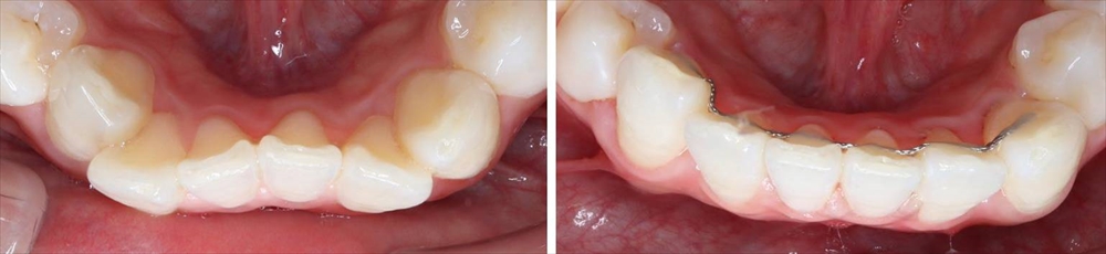 前歯の部分矯正の治療例（20代女性 治療期間5ヶ月）