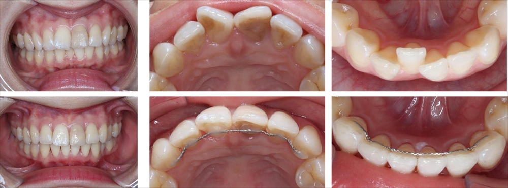 前歯の部分矯正(裏側矯正)の矯正治療例