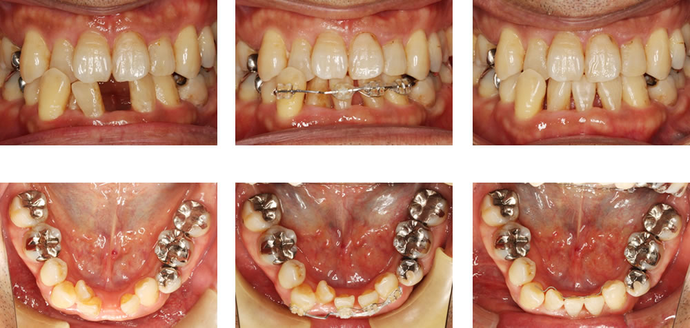 部分矯正の矯正治療例