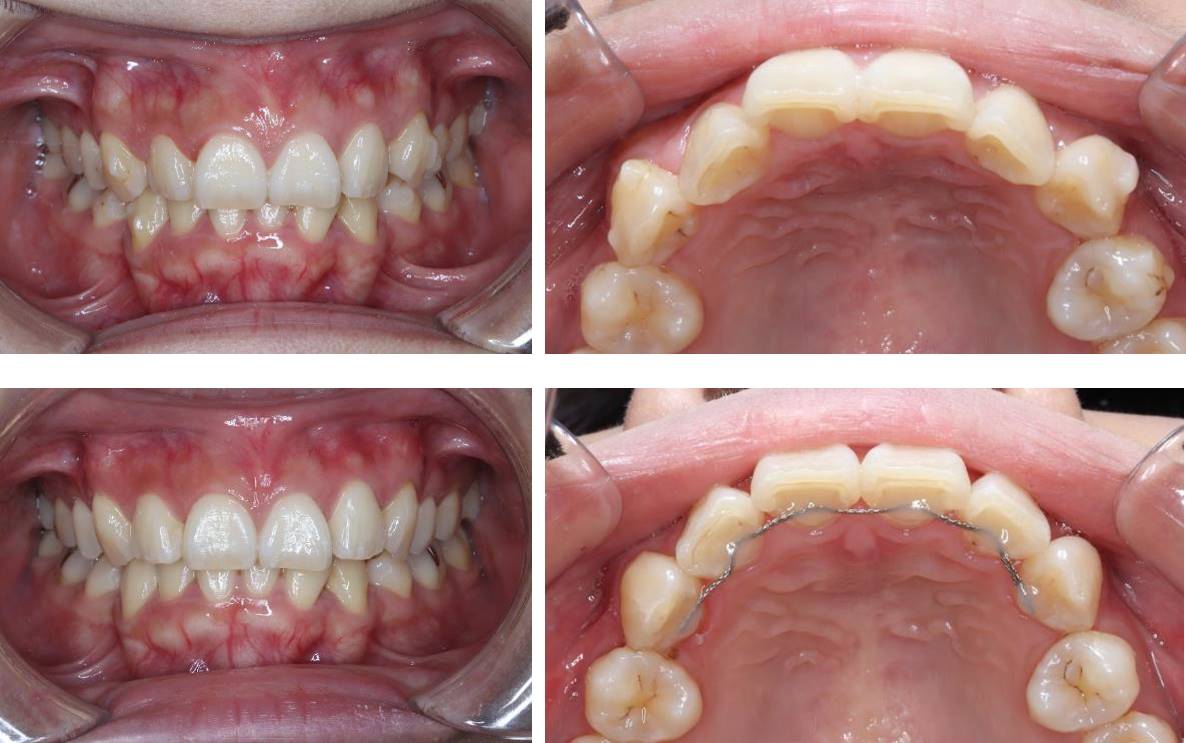 前歯の部分矯正(裏側矯正)の矯正治療例