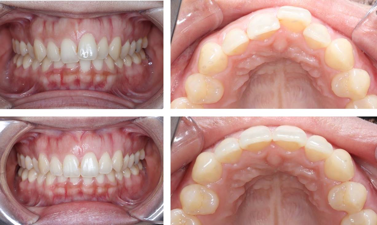 前歯の部分矯正(裏側矯正)の矯正治療例