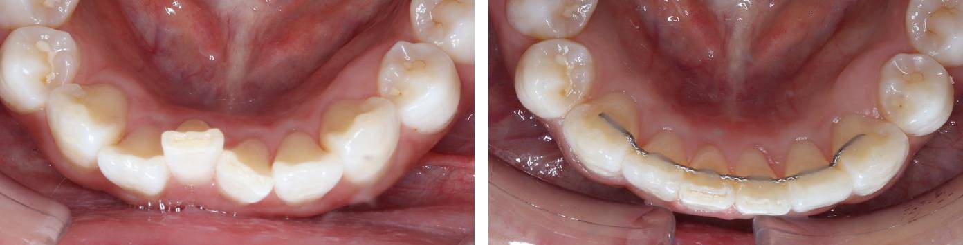 前歯の部分矯正(裏側矯正)の矯正治療例
