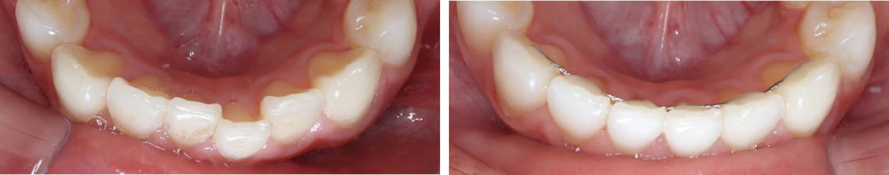 下の前歯の裏側部分矯正の治療例（20代女性 治療期間3ヶ月）