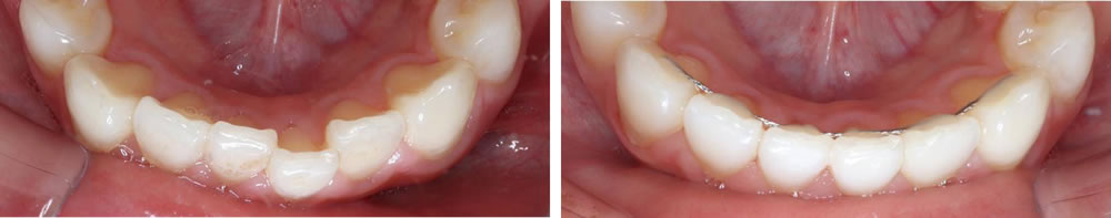 前歯の部分矯正(裏側矯正)の矯正治療例