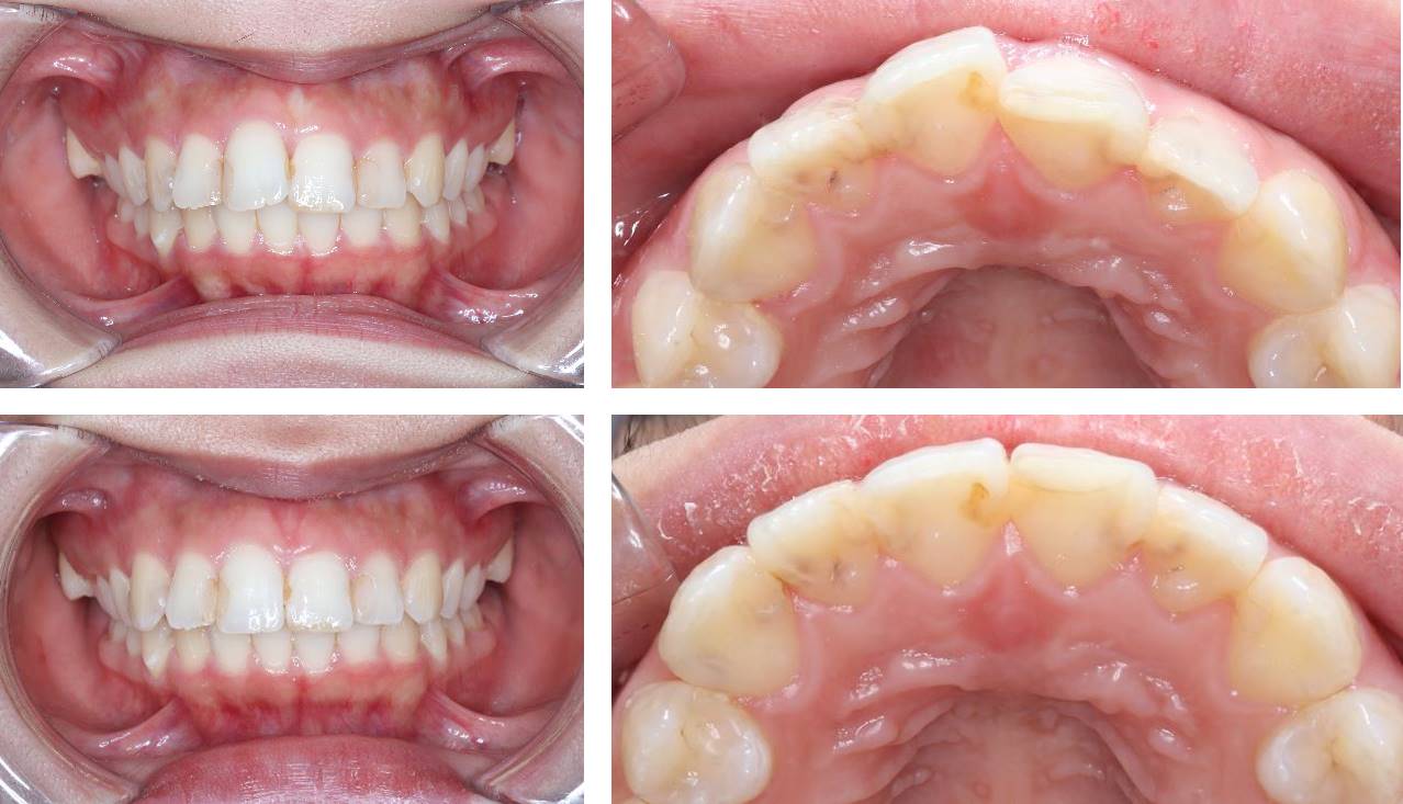 前歯の部分矯正(裏側矯正)の矯正治療例