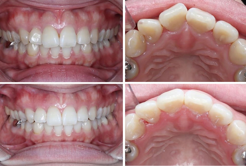 上の前歯の部分矯正の治療例 30代女性 治療期間11ヶ月 Uc矯正歯科クリニック麻布十番 東京港区