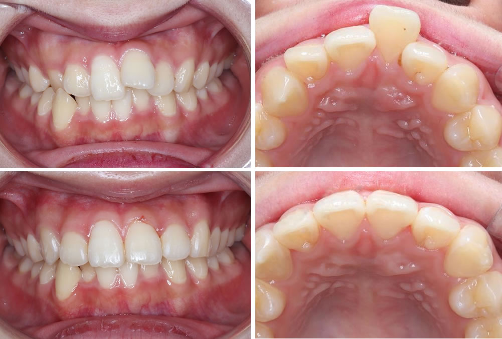 上の前歯の部分矯正の治療例（20代女性 治療期間6ヶ月）