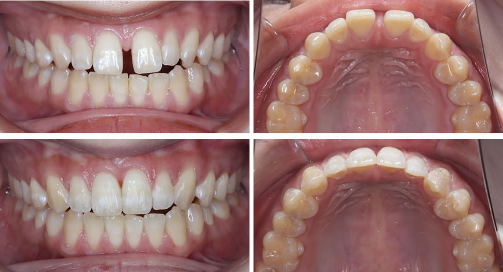 上の前歯の部分矯正の治療例（20代女性 治療期間6ヶ月）