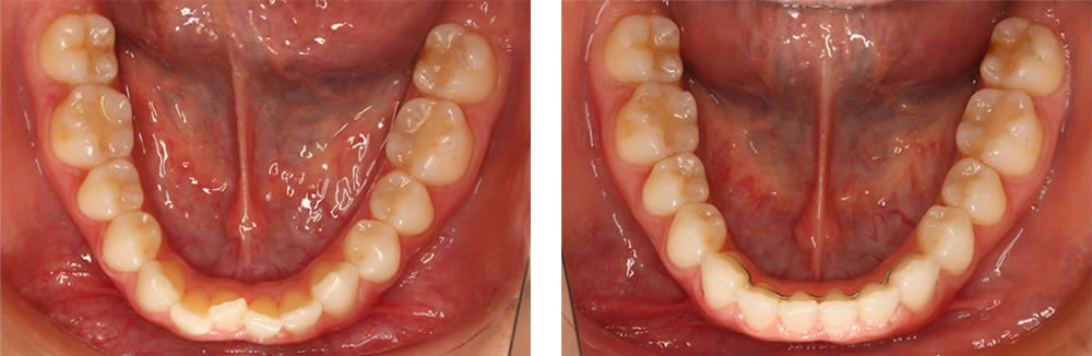 部分矯正の矯正治療例