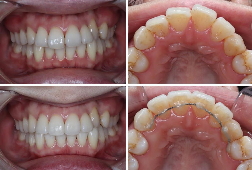 部分矯正(プチ矯正)の矯正治療例