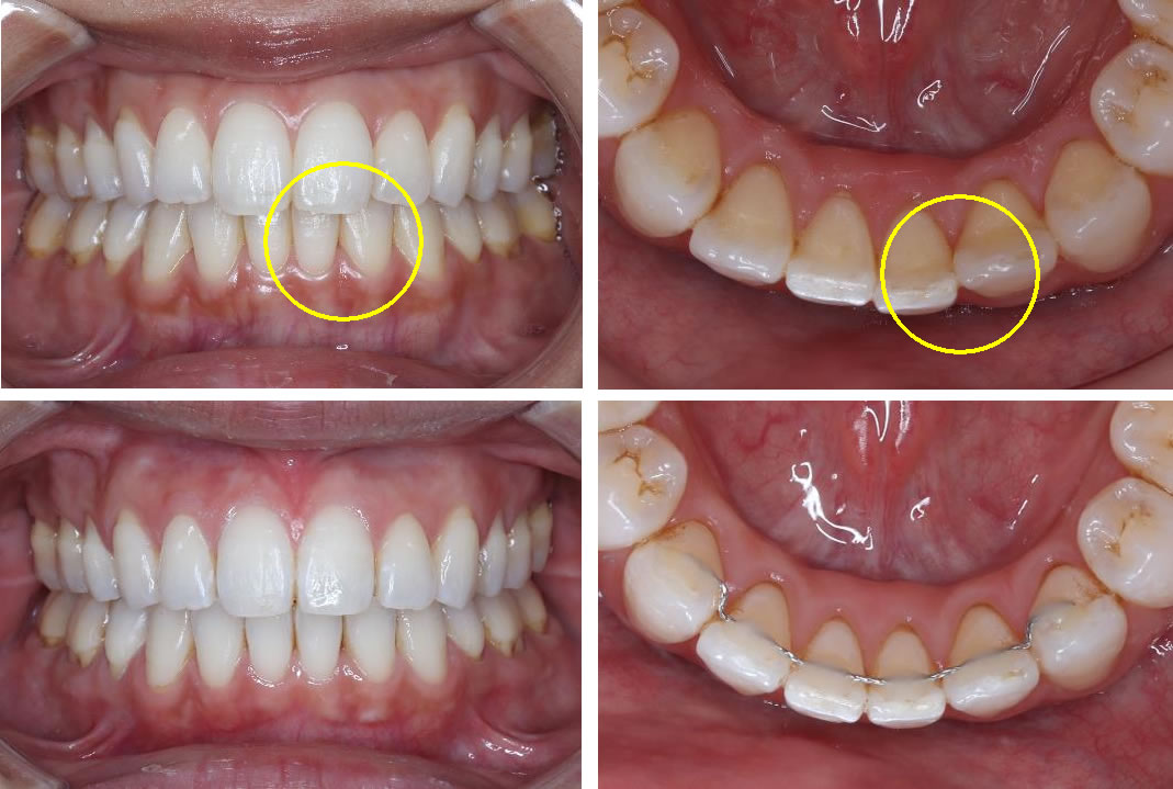 部分矯正(プチ矯正)の矯正治療例