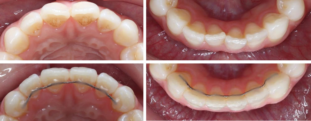 前歯の部分矯正(プチ矯正)の治療例（20代女性 治療期間6ヶ月）
