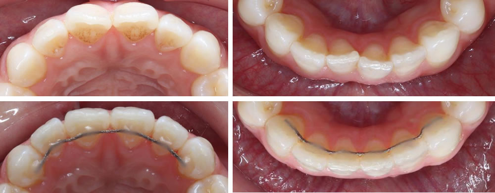 まえばの部分矯正(プチ矯正)の矯正治療例