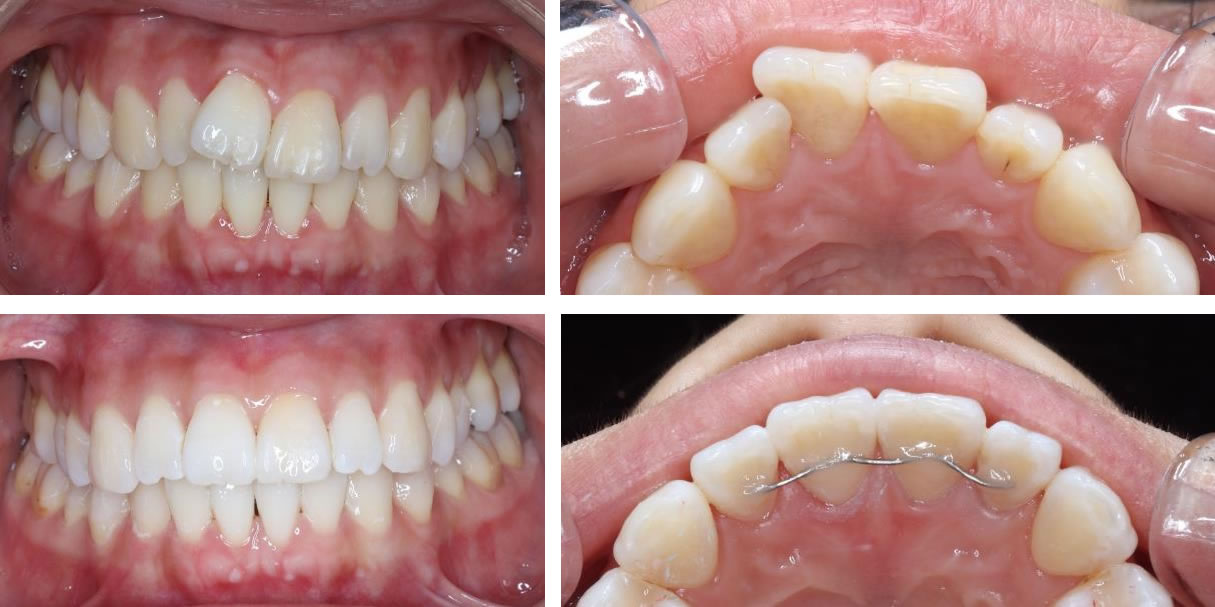 まえばの部分矯正(プチ矯正)の矯正治療例