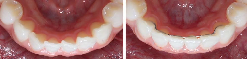 前歯の部分矯正(プチ矯正)の治療例（20代女性 治療期間4ヶ月）