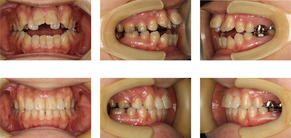 開咬（前歯が開く）の治療例