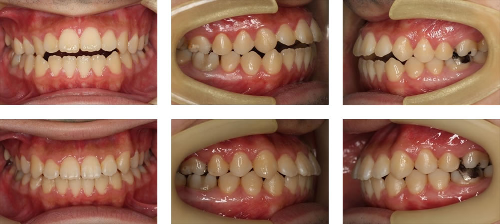 開咬（前歯が開く）の治療例