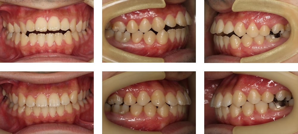 開咬の矯正治療例（２２０代男性・治療期間２年１ヶ月）