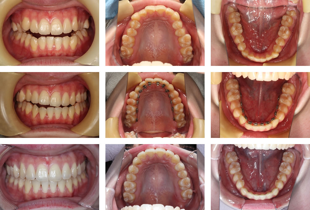 開咬の矯正治療例（10代女性 治療期間2年11ヶ月）