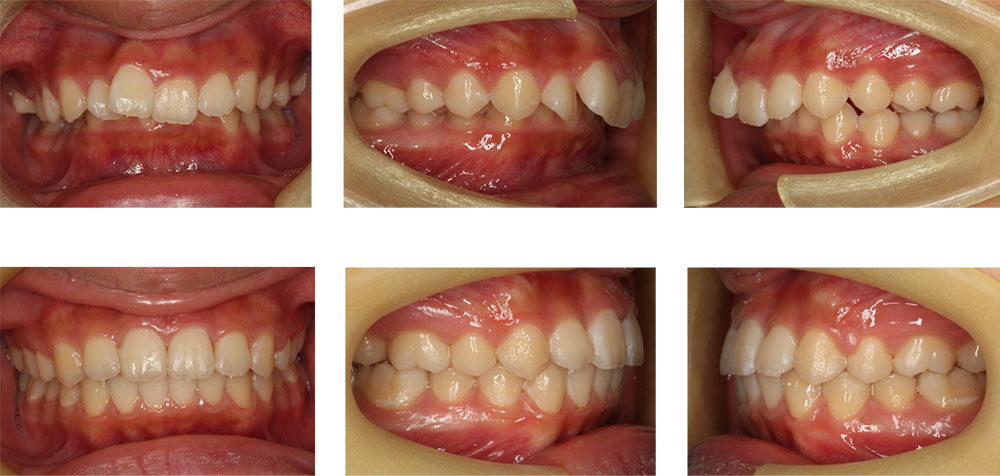 過蓋咬合の治療例