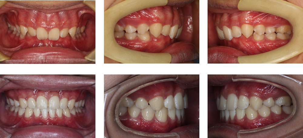 過蓋咬合の矯正治療例（10代男性 治療期間3年5ヶ月）