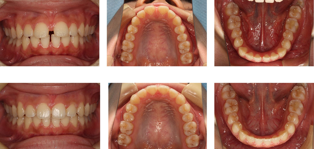 すきっ歯の治療例
