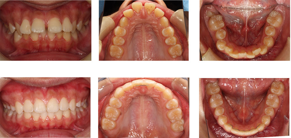 すきっ歯の治療例