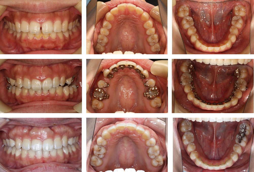 すきっ歯の矯正治療例（10代女性 治療期間6年2ヶ月）