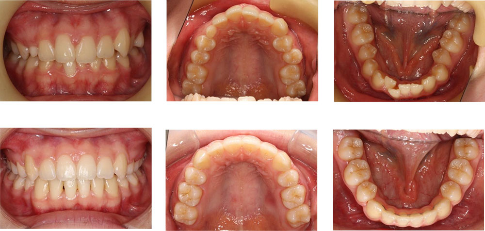 八重歯・叢生の治療例